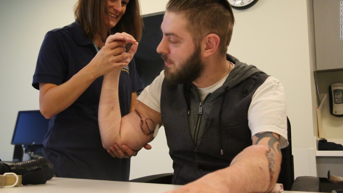 Wounded Veteran Receives Double Arm Transplant