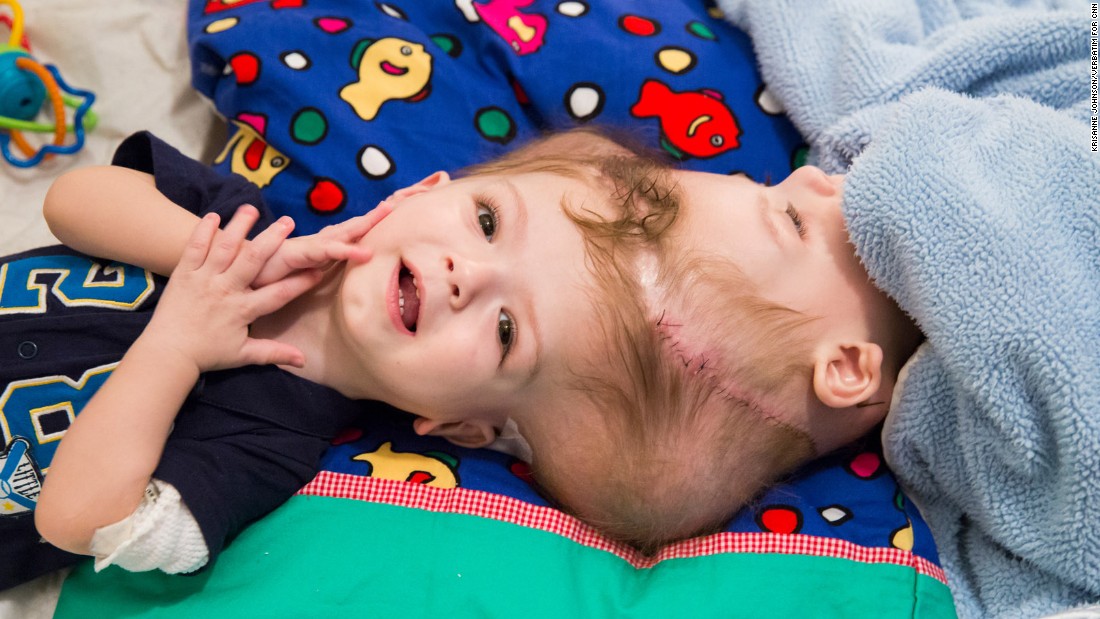 Anias, left, and Jadon McDonald were born conjoined at the head, something only seen in 1 out of every 2.5 million live births. They were separated in a 27-hour surgery at the Children&#39;s Hospital at Montefiore Medical Center in New York in October.