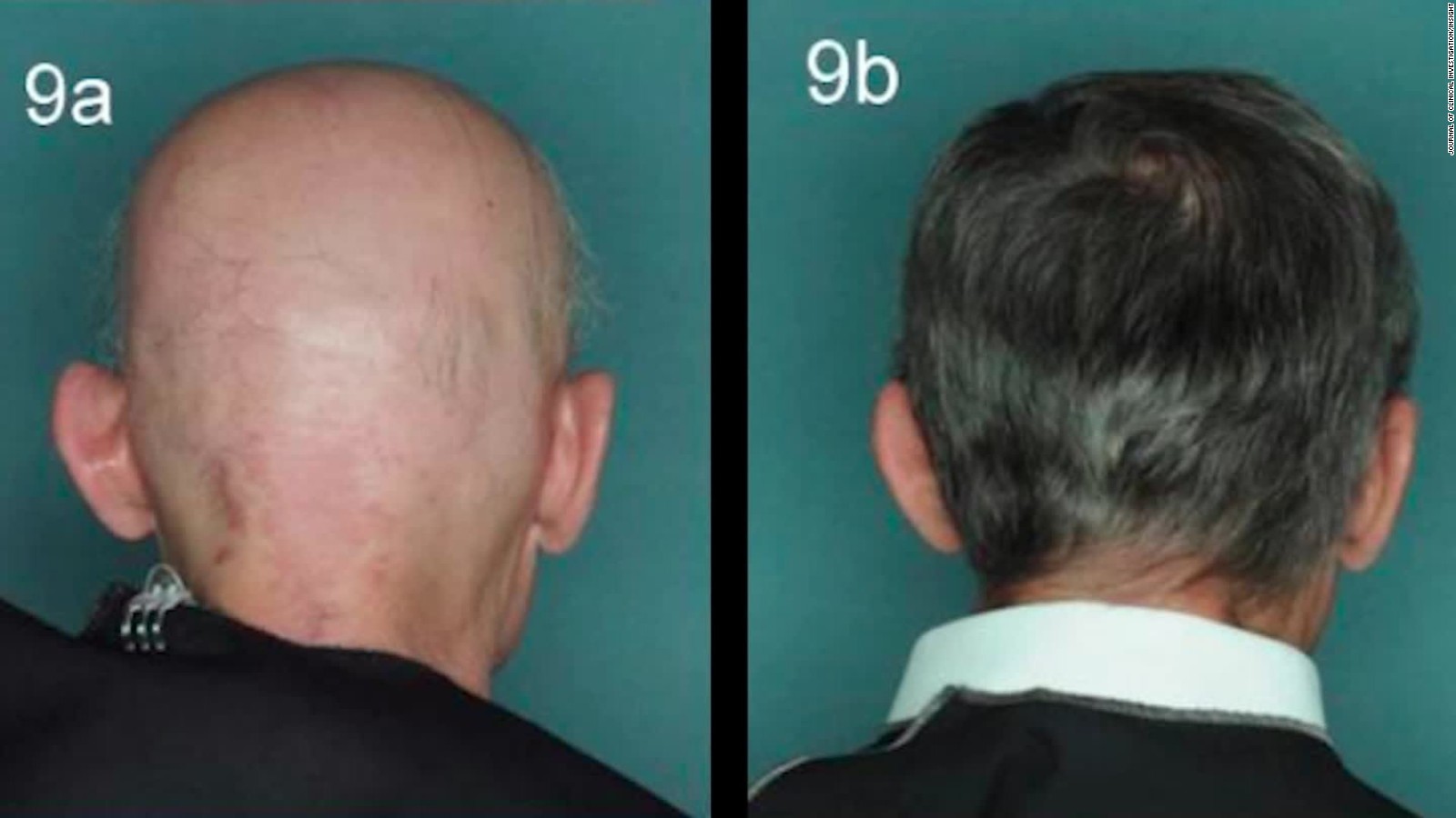 Drug Reverses One Baldness Type Is Male Pattern Next CNN