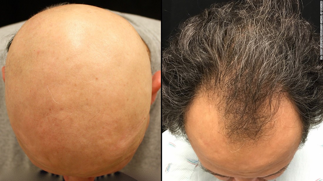 9 Best Mens HairLoss Treatments 2023  The Strategist