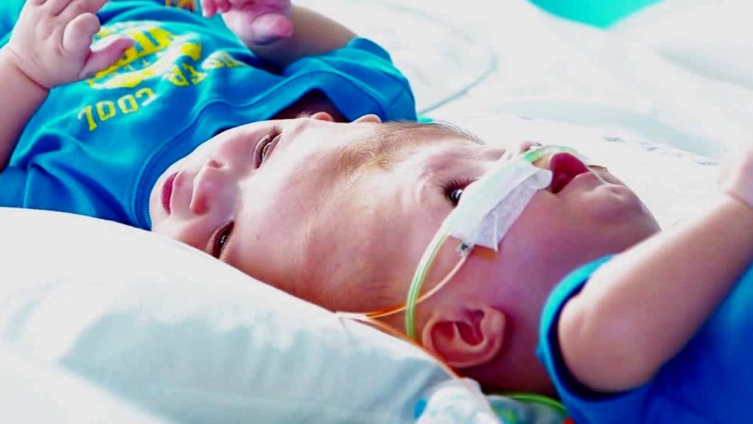 Formerly conjoined twins now in recovery CNN Video