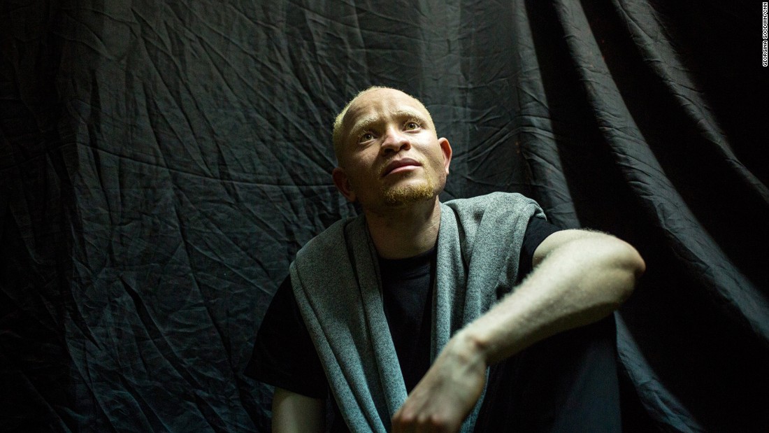 Some African societies see albinism as a curse or a sign of infidelity, which often leads to community ostracism. Pictured here is  contestant Andrew Ngune.