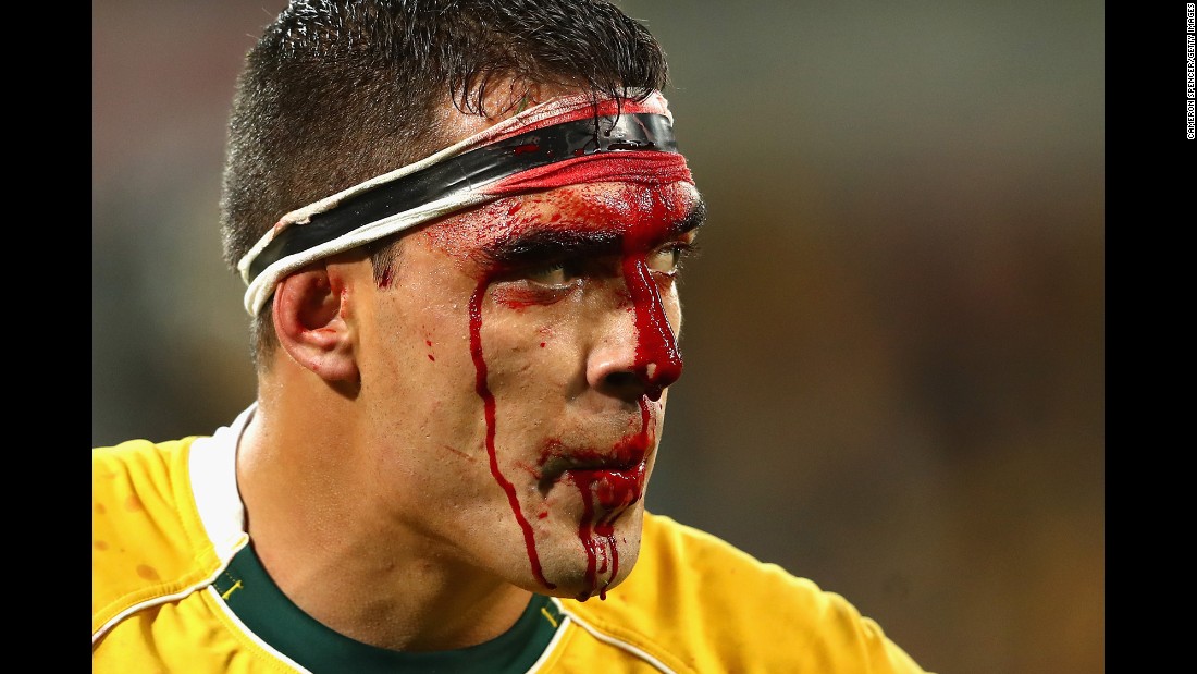 Australian rugby player Rory Arnold bleeds from his head Saturday, June 18, during a Test match against England in Melbourne.