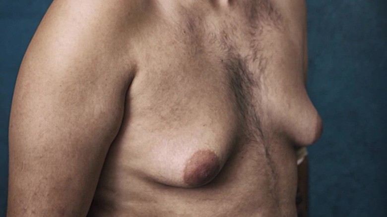 Men To Sue Over Drug That Made Them Grow Breasts Cnn