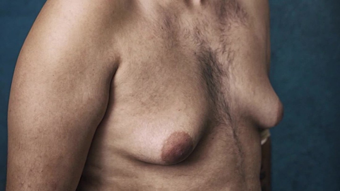 Men sue drug maker after developing breasts