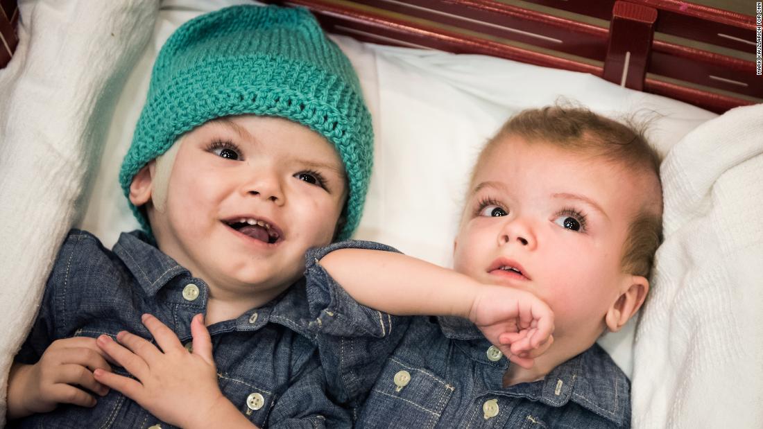 Conjoined Twins Separated New Life Apart 