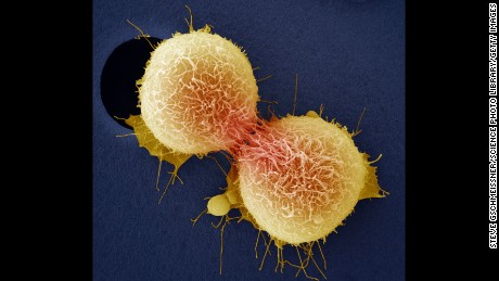 Cervical cancer death rates are much higher than thought, study says