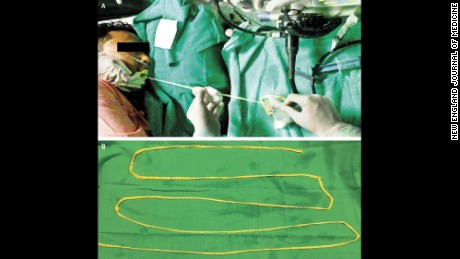 Doctors sedated the man and removed this 6-foot-long tapeworm through his mouth.