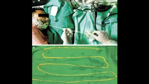 Doctors remove 6-foot tapeworm through man#39;s mouth