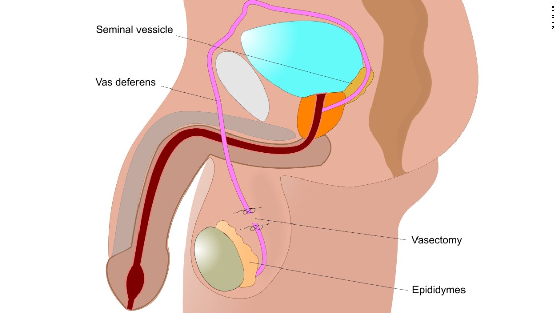 Male Reproductive System And Vasectomy Diagrams Sexiz Pix 