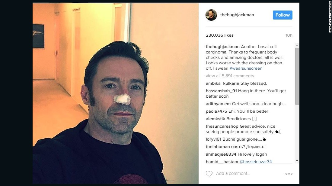 Hugh Jackman recently underwent treatment for basal cell carcinoma, again, according to a social media post. The Australian actor has been treated for basal cell carcinoma at least four times.