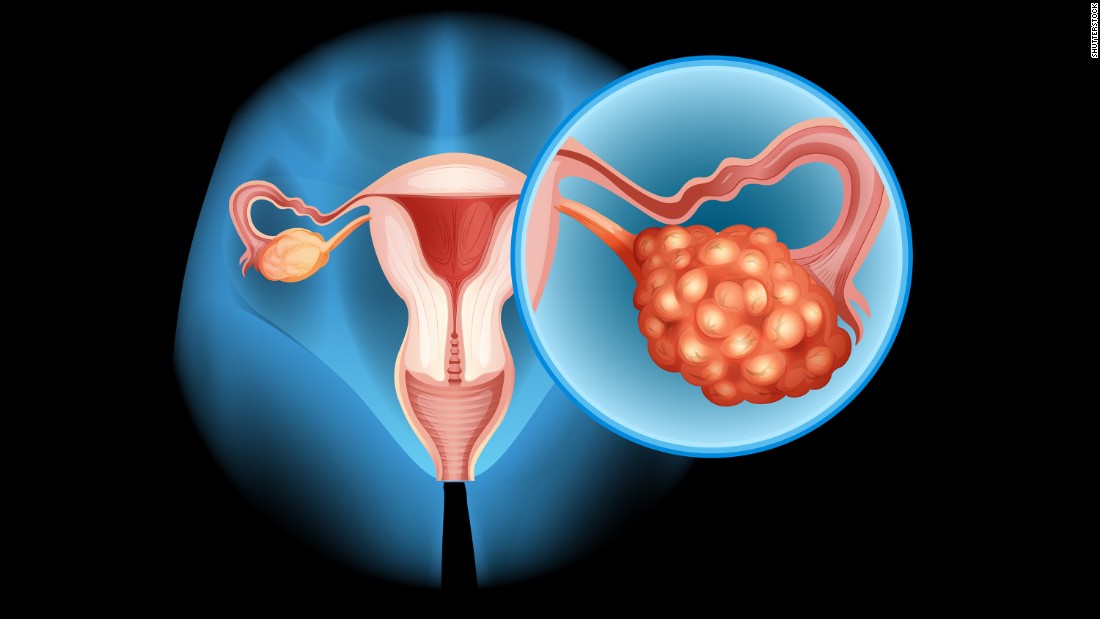 Ovarian cancer is a rare but deadly reason for a bloated belly. It usually goes along with other &lt;a href=&quot;http://www.bmj.com/content/339/bmj.b2998&quot; target=&quot;_blank&quot;&gt;telltale signs &lt;/a&gt;such as abdominal pain, urinary frequency, postmenopausal and anal bleeding, and a loss of appetite. So if you&#39;ve suddenly developed abdominal distension in the past few months and have any of these other symptoms, see a doctor immediately. And don&#39;t rely on the results of your Pap test; that&#39;s effective only in the early detection of cervical cancer.