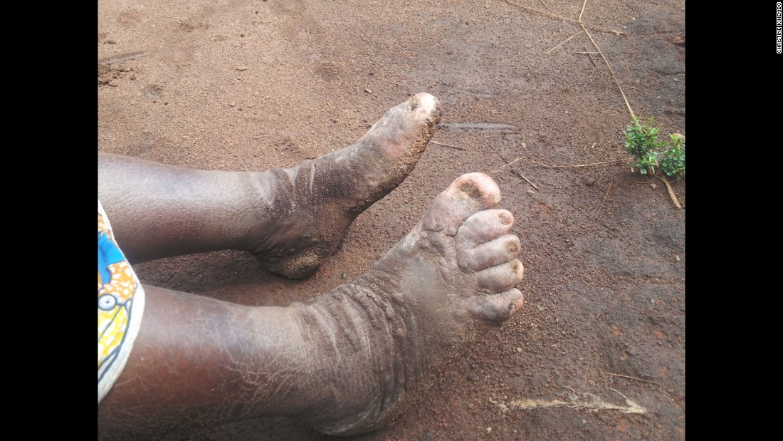 Volcanic soil behind mystery outbreak of elephantiasis - CNN