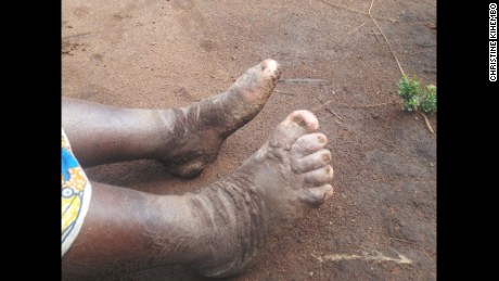 Volcanic minerals behind mystery elephantiasis outbreak in Uganda