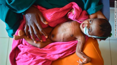 TOPSHOT - A severely malnourished child in the hands of her mother waits to be processed into a UNICEF- funded health programme catering to children displaced by drought, at the regional hospital in Baidoa town, the capital of Bay region of south-western Somalia where the spread of cholera has claimed tens of lives of IDP&#39;s compounding the impact of drought on March 15, 2017.
The United Nations is warning of an unprecedented global crisis with famine already gripping parts of South Sudan and looming over Nigeria, Yemen and Somalia, threatening the lives of 20 million people. For Somalis, the memory of the 2011 famine which left a quarter of a million people dead is still fresh.
 / AFP PHOTO / TONY KARUMBA        (Photo credit should read TONY KARUMBA/AFP/Getty Images)