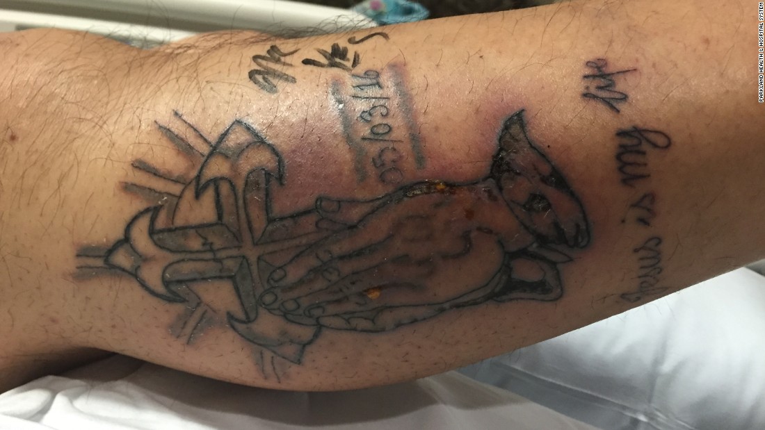 A 31-year-old Texas man got a tattoo on his right leg, according to a case study in the journal BMJ, and went swimming in the Gulf of Mexico five days later.