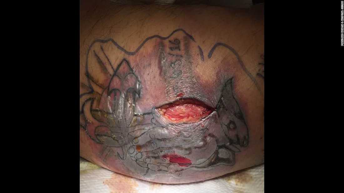 75+ Free Download Tattoo Infection Idea Tattoo Photos