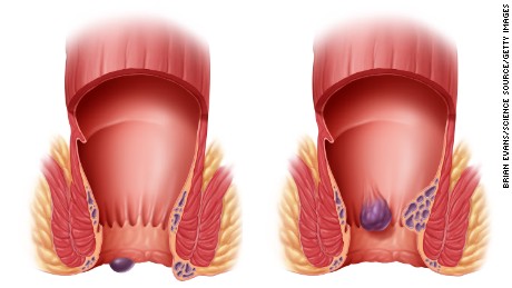 Äußere, linke und innere Hämorrhoiden