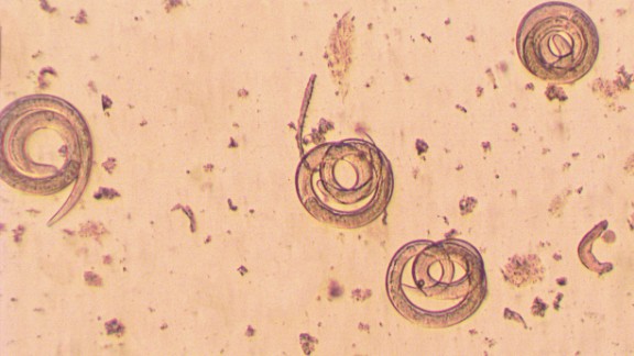 Trichinella pinworms hogyan lehet kezelni a szempillákat a parazitáktól