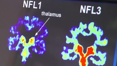 Study Cte In 99 Of Dead Nfl Players