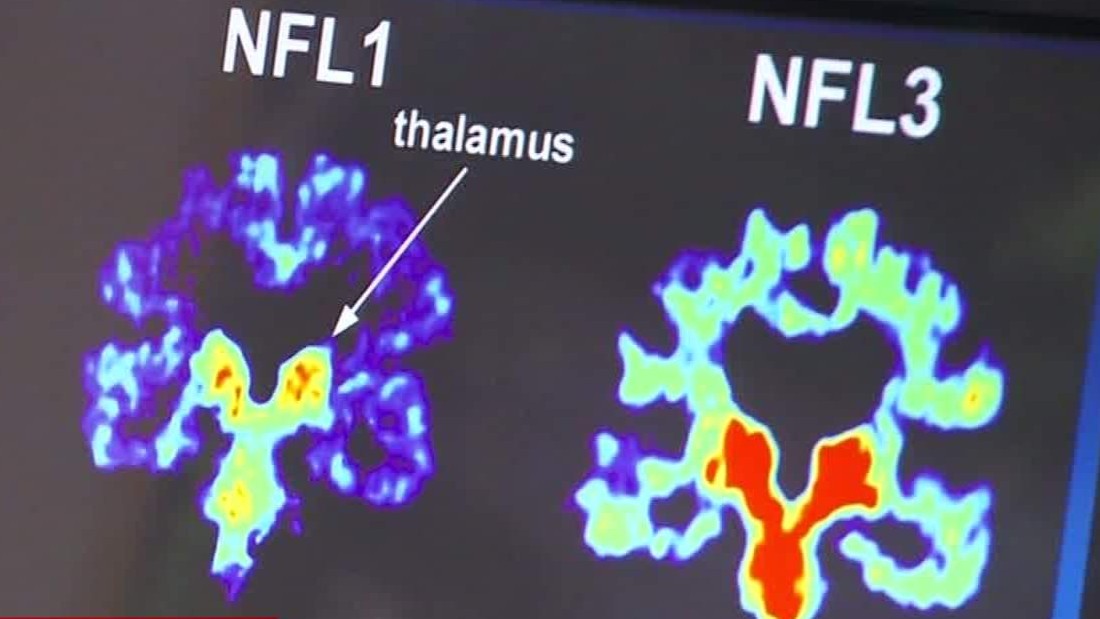 Philip Adams: Former NFL player who killed 6 had 'unusually severe' stage 2  CTE that can change behavior, expert says