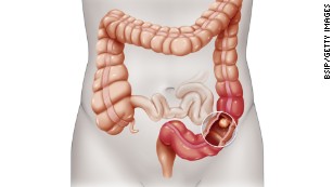 Colorectal cancer: What you need to know