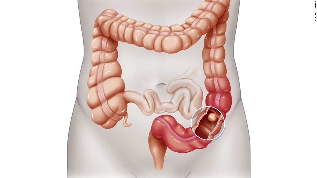 rectal cancer and colon cancer