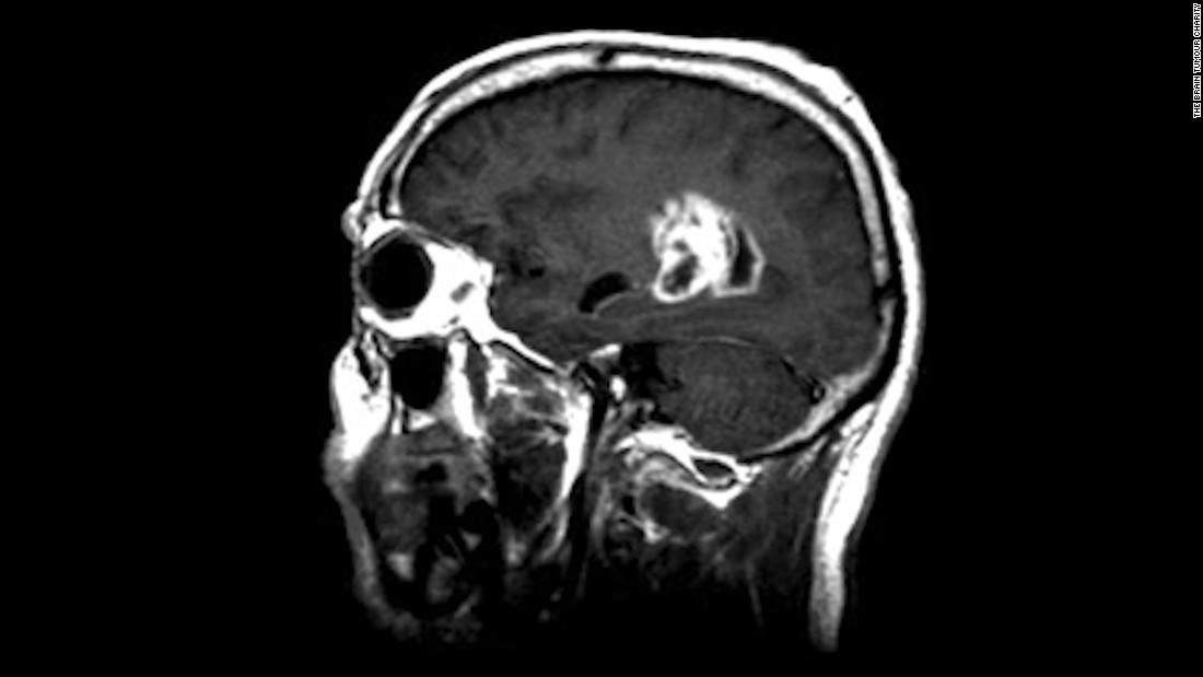 What Is Glioblastoma CNN Video what-is-glioblastoma-cnn-video