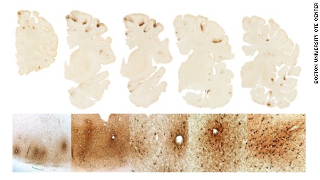 Boston University&#39;s CTE Center said Aaron Hernandez&#39;s brain, above, shows &quot;classic features of CTE.&quot;