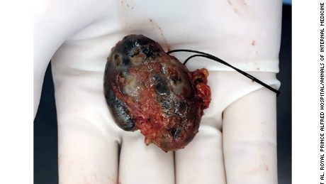 The lymph node that was removed from the woman&#39;s armpit.