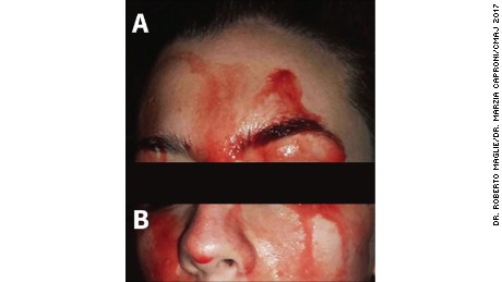 A young woman was sweating blood from her face and palms, a recent case study said.