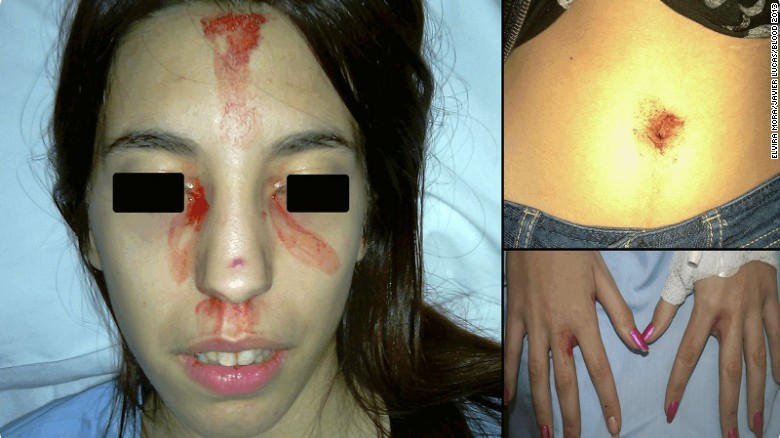 Woman Sweats Blood From Face baffles Doctors