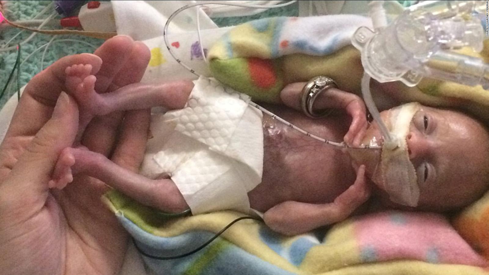 born-before-22-weeks-most-premature-baby-is-now-thriving-cnn