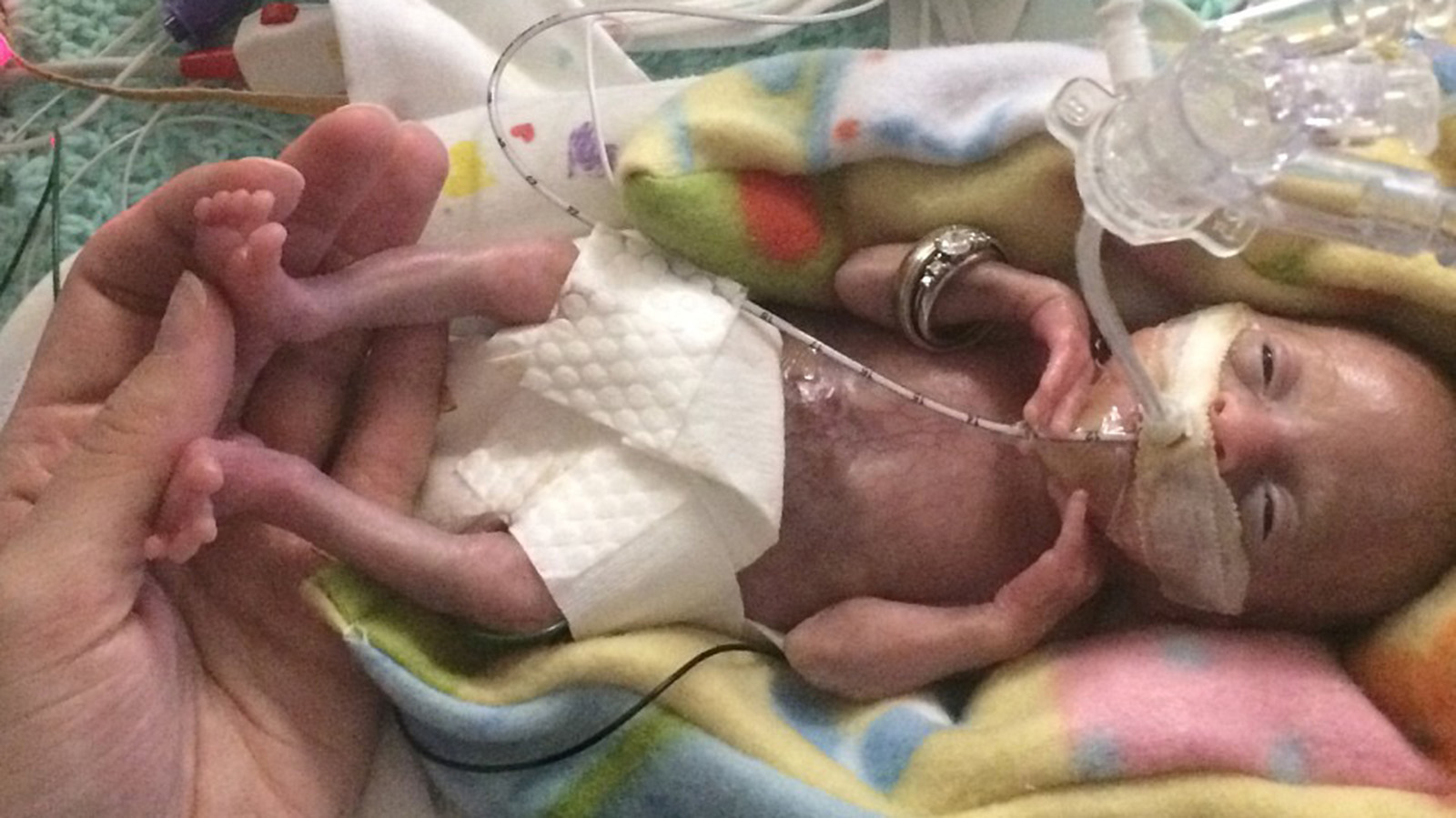 Born Before 22 Weeks Most Premature Baby Is Now Thriving Cnn