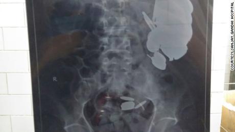 X-rays showed a number of foreign objects in the patient&#39;s stomach.
