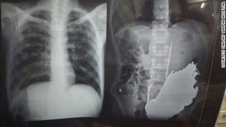 Another X-ray showing foreign objects in the patient&#39;s stomach.