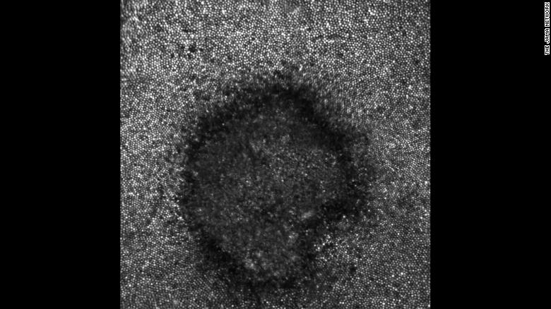 The adaptive optics image of Payne&#39;s retina revealed a crescent shape.