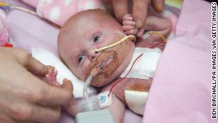 Baby born with heart outside her body survives surgery - CNN