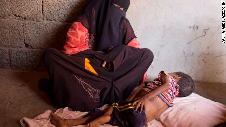 In Yemen, the markets have food, but children are starving to death 