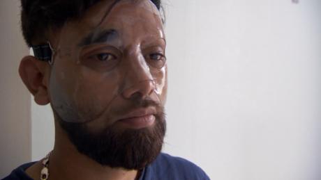 Acid attacks on the rise in Britain