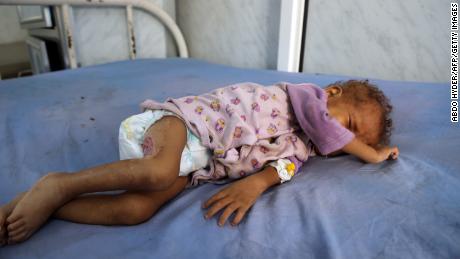 A malnourished Yemeni child receives treatment at a hospital in the Yemeni port city of Hodeidah in December. The United Nations has listed Yemen as the world's No. 1 humanitarian crisis.