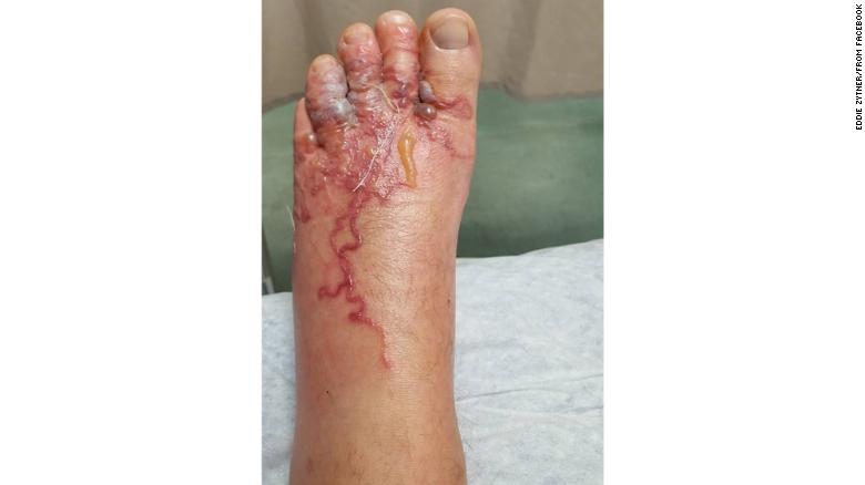 Cutaneous larva migrans occurs when hookworm larvae get into the skin.