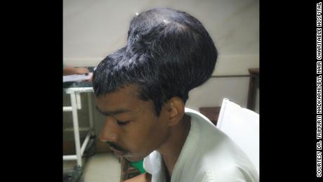 Sanlal Pal, 31, had a  a 1.873 kg (4.1 lb) removed from his brain by surgeons at BYL Nair Charitable Hospital in India.