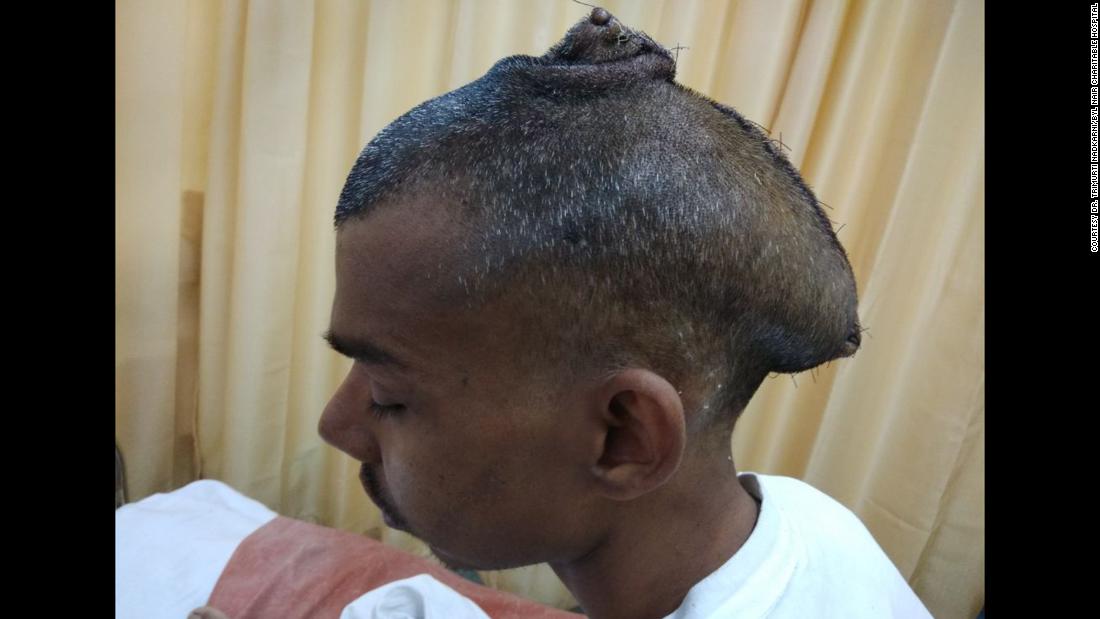 Indian Doctors Remove Brain Tumor Thought To Be Largest In The World 6176