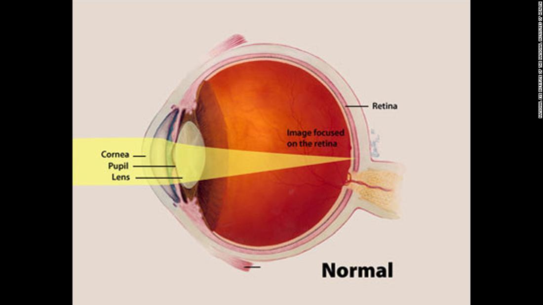 This illustration highlights the cornea, pupil and lens of a normal eye and how an image focuses on the retina.