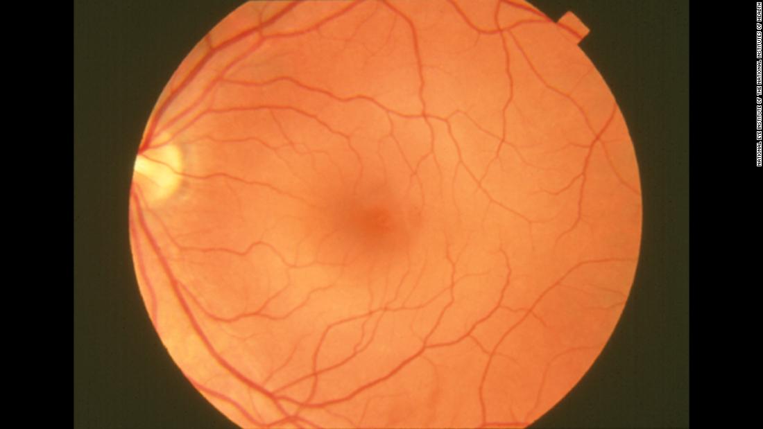 This photograph of a normal retina reveals the vascular, or circulatory, system structures.