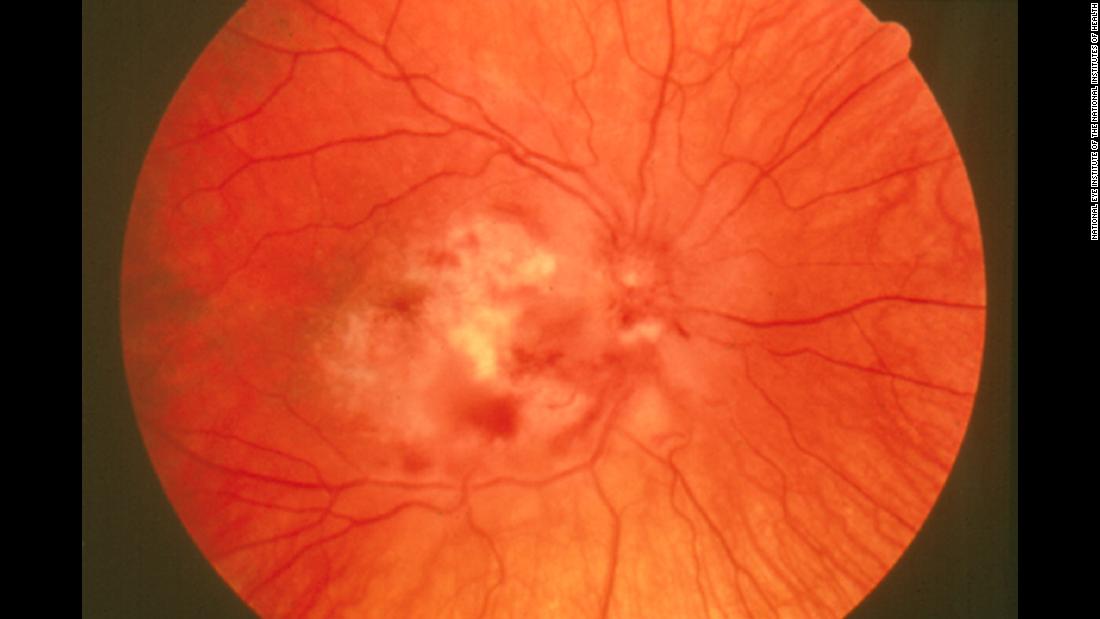 Cytomegalovirus (CMV) retinitis is caused by the herpes viruses that infects most adults. It is a serious eye infection, with symptoms that usually occur in people with weakened immune systems. Untreated, it can lead to vision problems.