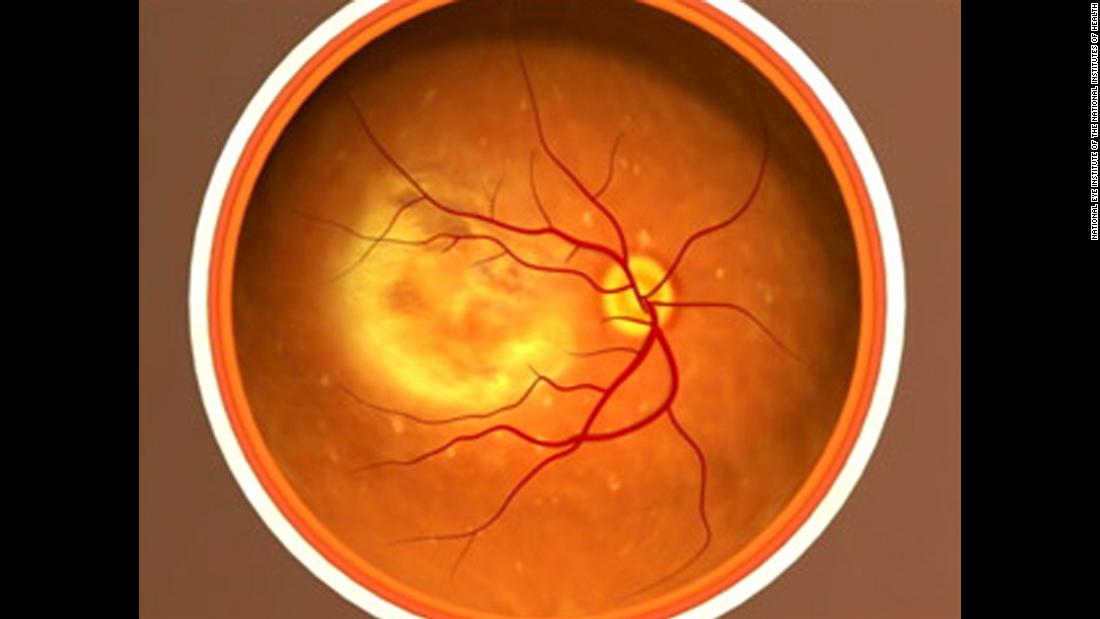 This photograph shows &lt;a href=&quot;https://nei.nih.gov/health/maculardegen/armd_facts&quot; target=&quot;_blank&quot;&gt;age-related macular degeneration&lt;/a&gt;, the leading cause of vision loss among people 50 and older, with fibrosis. It causes damage to the macula, a small spot near the center of the retina. The macula is the part of the eye needed for sharp, central vision.