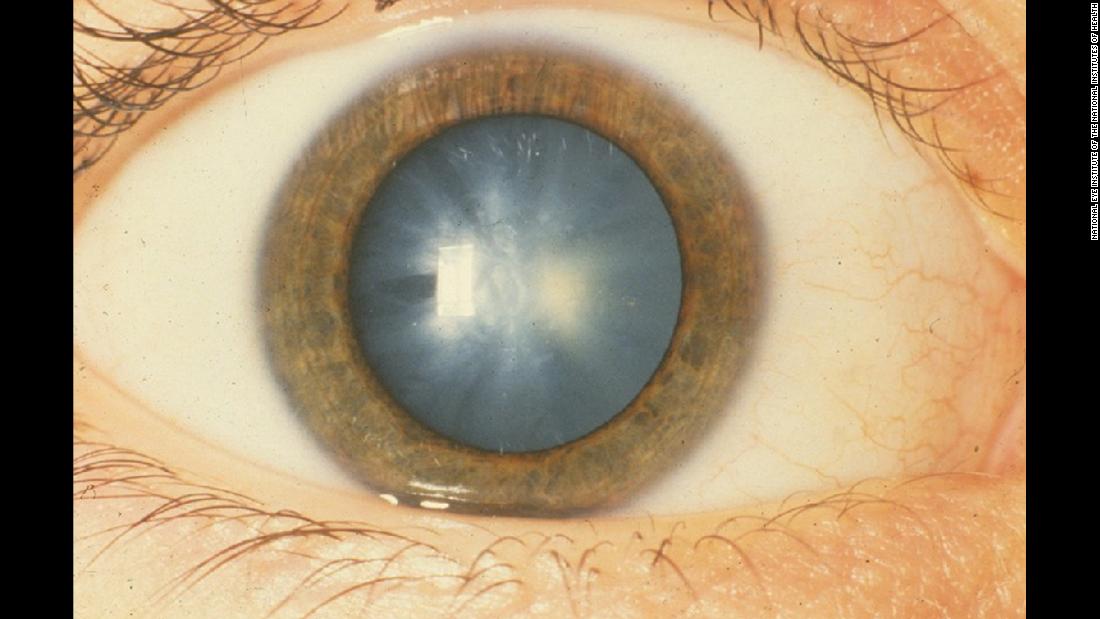 This photograph shows a white congenital cataract, an opacification (or unclear density) of the lens that was diagnosed at birth.