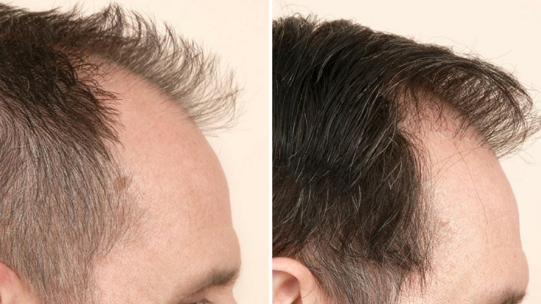 Relacion entre cetosis y caida cabello